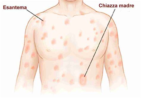 Uomo con eruzione cutanea di pitiriasi rosea sul tronco
