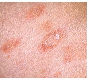 Confronto visivo tra pitiriasi rosea e sifilide secondaria