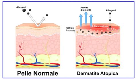 Pelle sana vs pelle con dermatite atopica