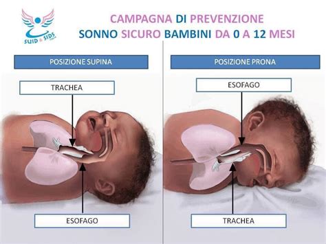 Neonato in posizione supina con testa ruotata