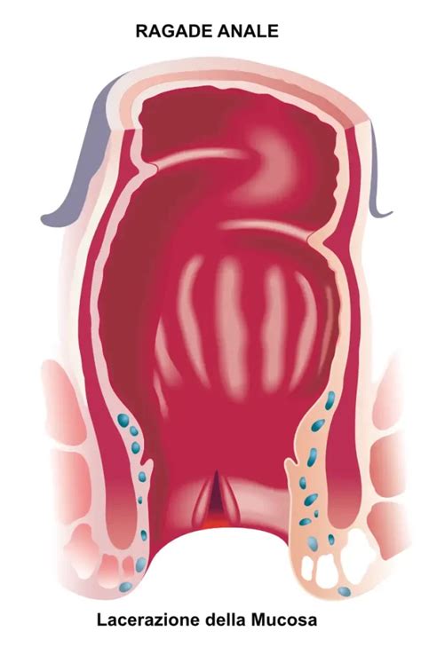 Infografica che confronta i diversi trattamenti per le ragadi anali