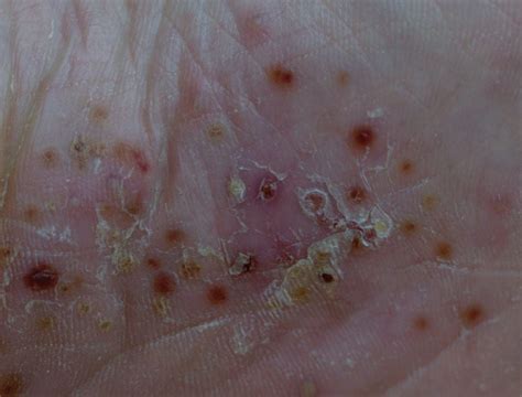 Diagramma che illustra le diverse manifestazioni della psoriasi, con enfasi sulla psoriasi pustolosa generalizzata.