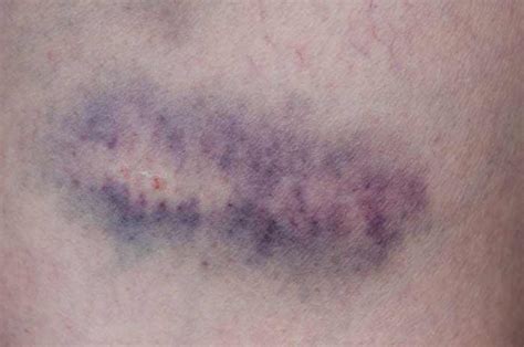 Immagine che mostra diverse manifestazioni di porpora: petecchie, porpora e ecchimosi.