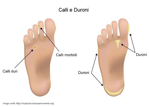 Immagine di calli e duroni sui piedi