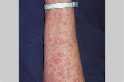 Illustrazione delle principali reazioni cutanee da farmaco (es. sindrome di Stevens-Johnson)