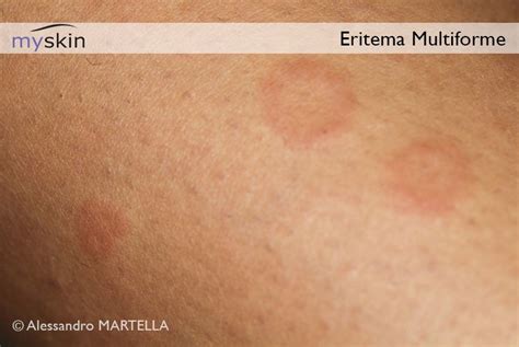 Lesioni a bersaglio dell'eritema multiforme