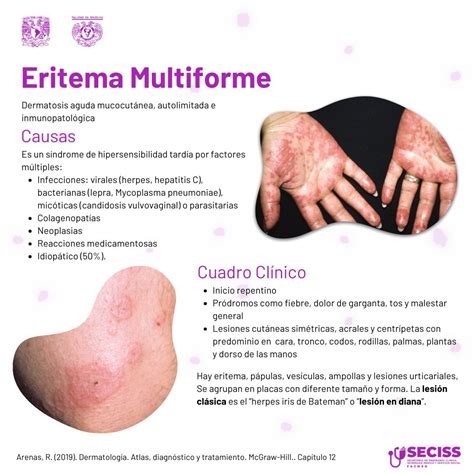 Diagramma comparativo Eritema Polimorfo vs Eritema Multiforme