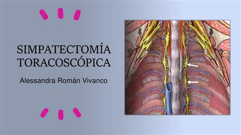 Schema della simpaticectomia toracica endoscopica